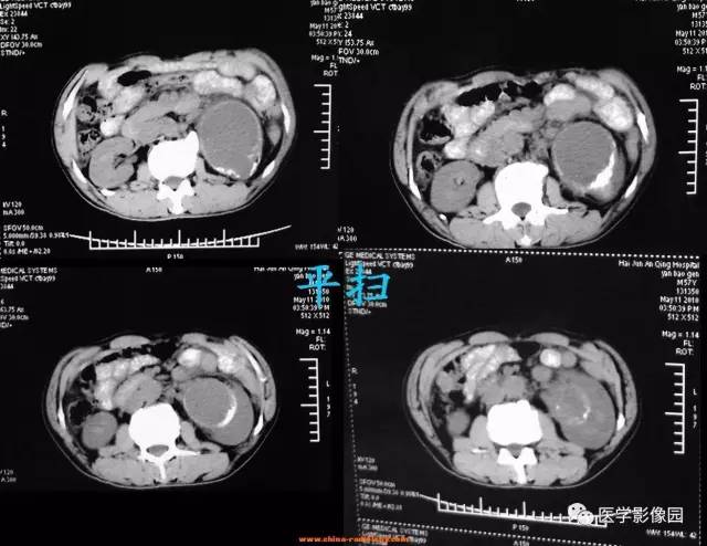 【病例】左侧肾上腺腺癌1例CT影像表现 【病例】左侧肾上腺腺癌1例CT影像表现