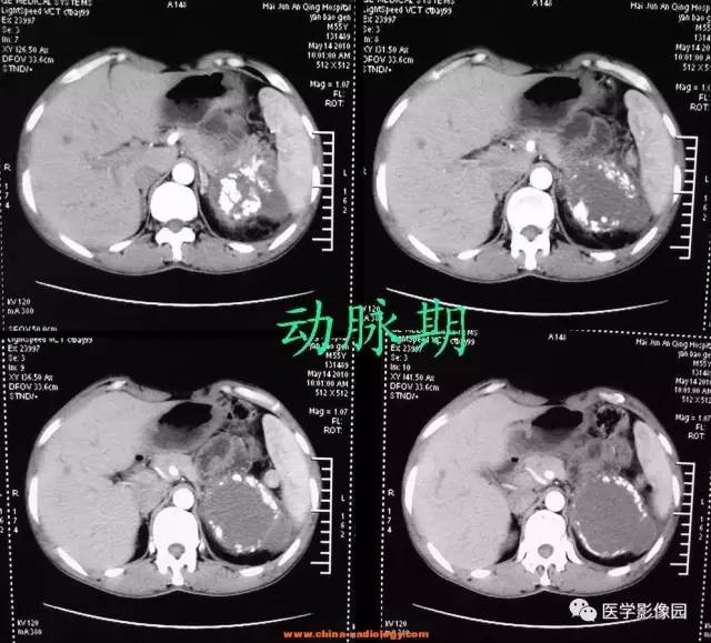 【病例】左侧肾上腺腺癌1例CT影像表现 【病例】左侧肾上腺腺癌1例CT影像表现
