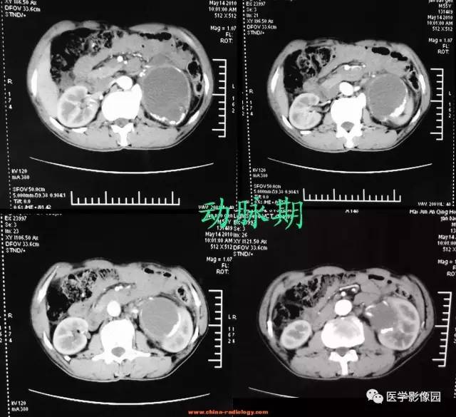 【病例】左侧肾上腺腺癌1例CT影像表现 【病例】左侧肾上腺腺癌1例CT影像表现