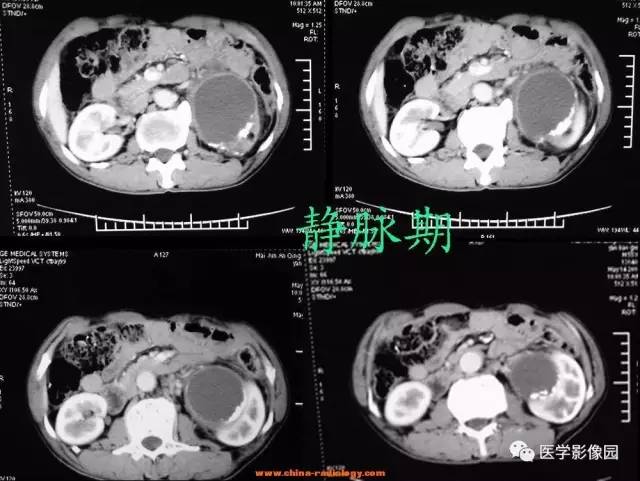 【病例】左侧肾上腺腺癌1例CT影像表现 【病例】左侧肾上腺腺癌1例CT影像表现