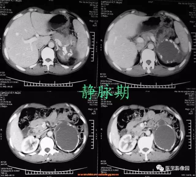 【病例】左侧肾上腺腺癌1例CT影像表现 【病例】左侧肾上腺腺癌1例CT影像表现