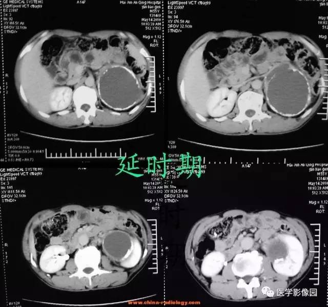 【病例】左侧肾上腺腺癌1例CT影像表现 【病例】左侧肾上腺腺癌1例CT影像表现