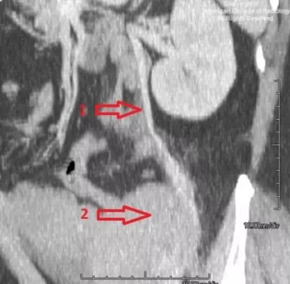 【病例】鉴别诊断千万别把它漏掉:卵巢淋巴瘤1例 【病例】鉴别诊断千万别把它漏掉:卵巢淋巴瘤1例
