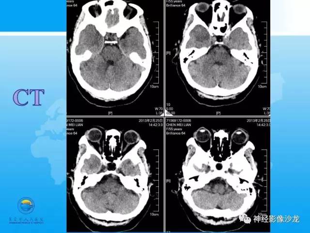 【病例】血管瘤型脑膜瘤VS实性血管母CT及MR