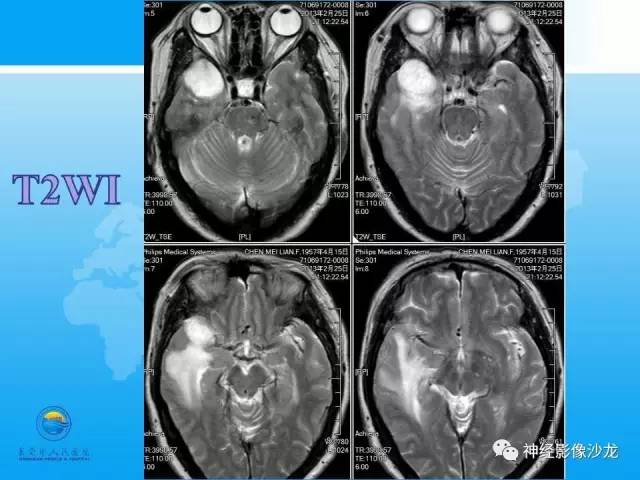 【病例】血管瘤型脑膜瘤VS实性血管母CT及MR