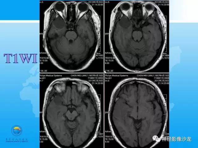 【病例】血管瘤型脑膜瘤VS实性血管母CT及MR