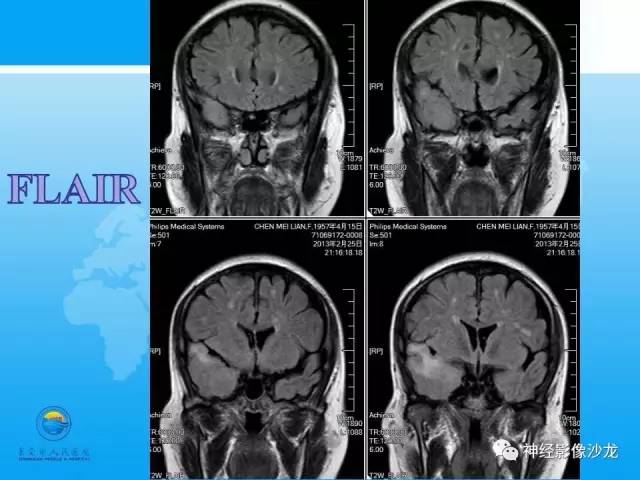 【病例】血管瘤型脑膜瘤VS实性血管母CT及MR