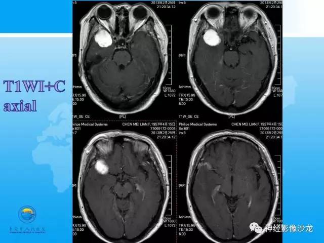 【病例】血管瘤型脑膜瘤VS实性血管母CT及MR