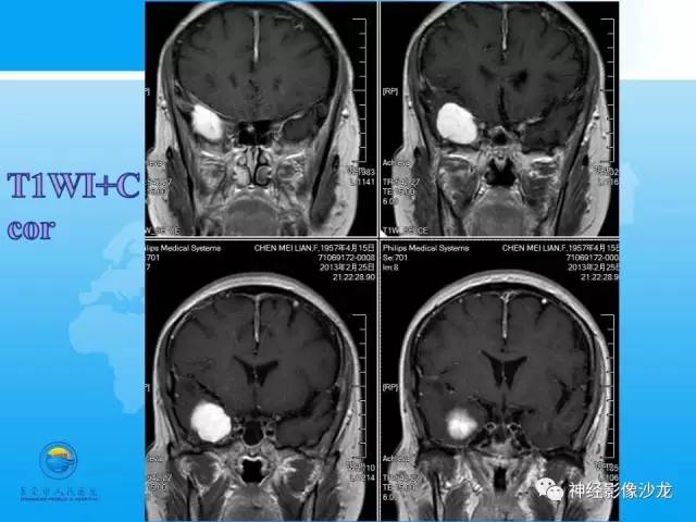 【病例】血管瘤型脑膜瘤VS实性血管母CT及MR