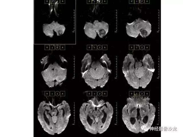 【病例】血管瘤型脑膜瘤VS实性血管母CT及MR