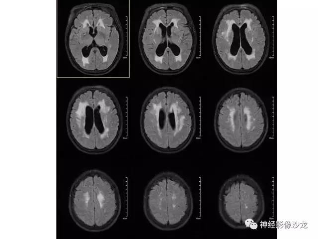【病例】血管瘤型脑膜瘤VS实性血管母CT及MR