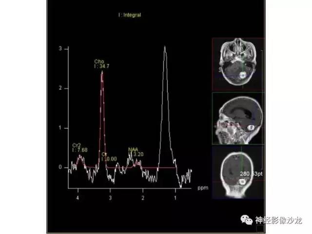 【病例】血管瘤型脑膜瘤VS实性血管母CT及MR