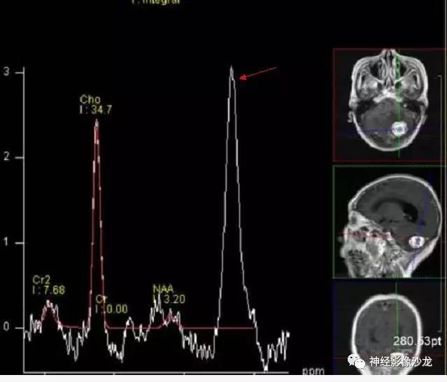 【病例】血管瘤型脑膜瘤VS实性血管母CT及MR