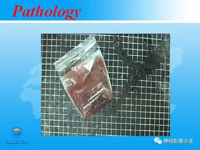 【病例】血管瘤型脑膜瘤VS实性血管母CT及MR