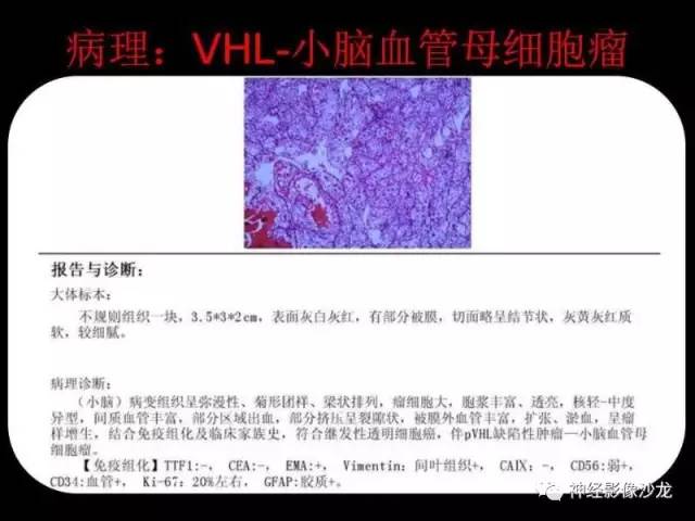 【病例】血管瘤型脑膜瘤VS实性血管母CT及MR