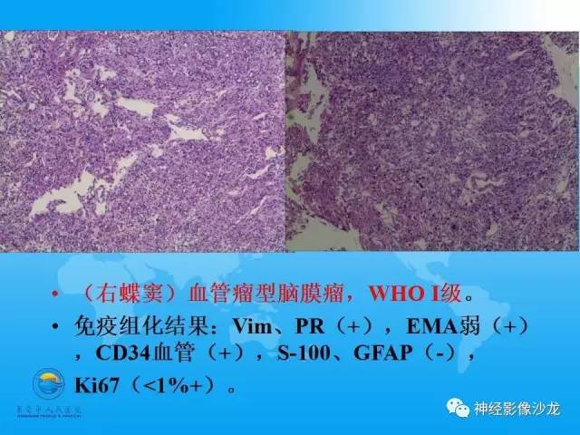 【病例】血管瘤型脑膜瘤VS实性血管母CT及MR