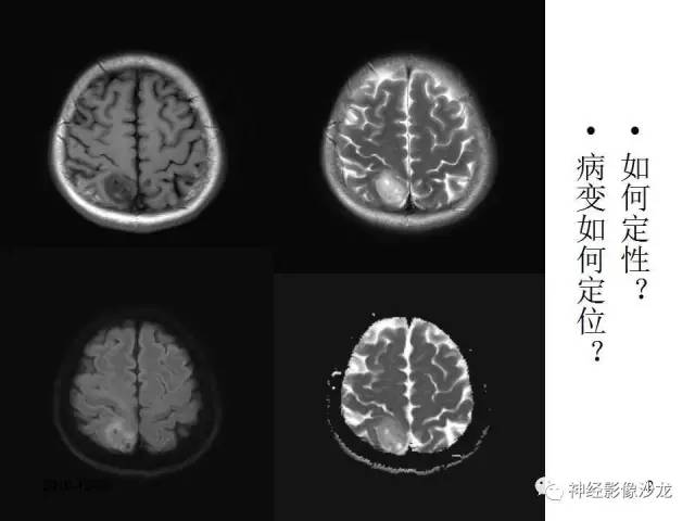 【病例】右顶叶混合性胶质瘤1例MR影像讨论 【病例】右顶叶混合性胶质瘤1例MR影像讨论