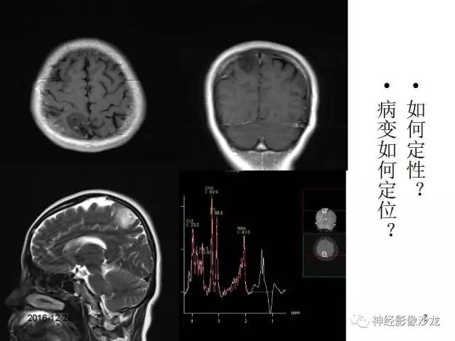 【病例】右顶叶混合性胶质瘤1例MR影像讨论 【病例】右顶叶混合性胶质瘤1例MR影像讨论
