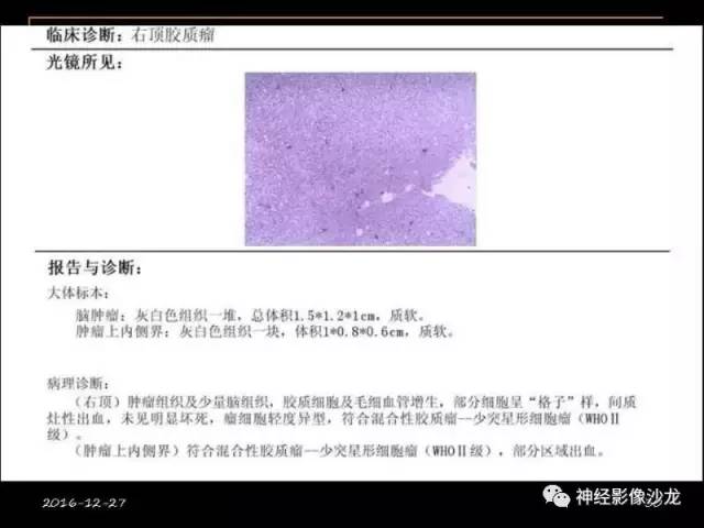 【病例】右顶叶混合性胶质瘤1例MR影像讨论 【病例】右顶叶混合性胶质瘤1例MR影像讨论