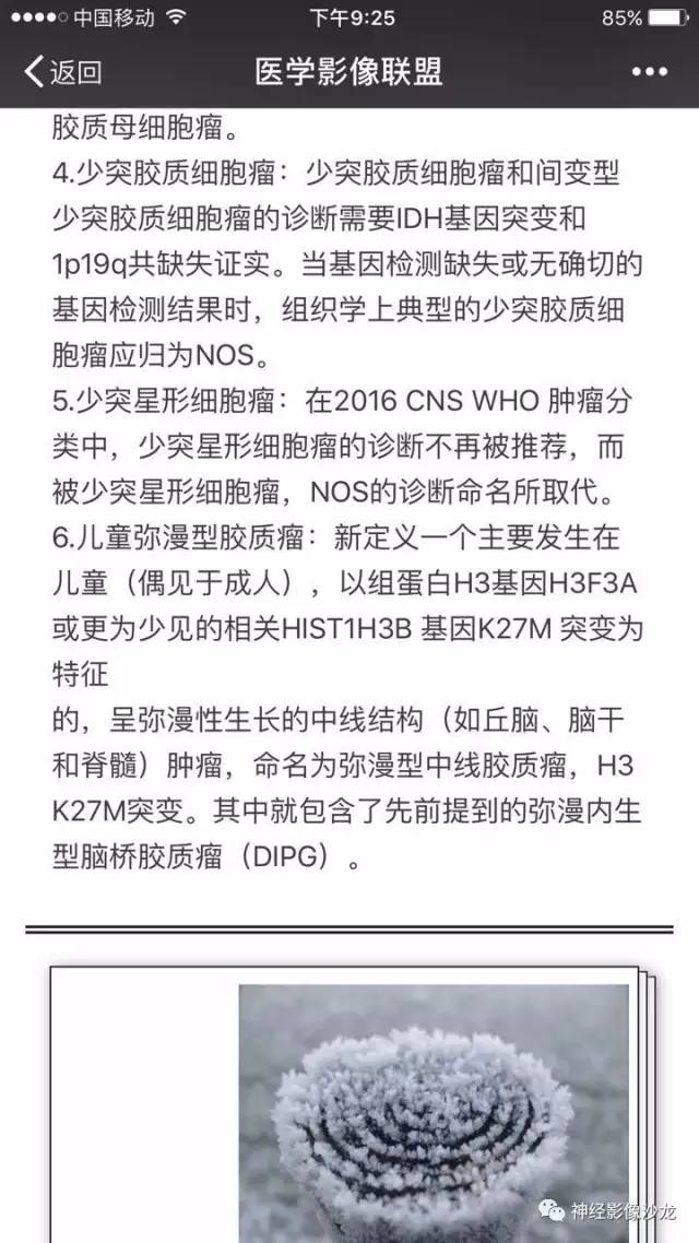 【病例】右顶叶混合性胶质瘤1例MR影像讨论 【病例】右顶叶混合性胶质瘤1例MR影像讨论