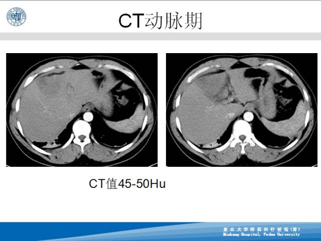 【病例】肝左叶胆管细胞癌1例CT及MR影像表现