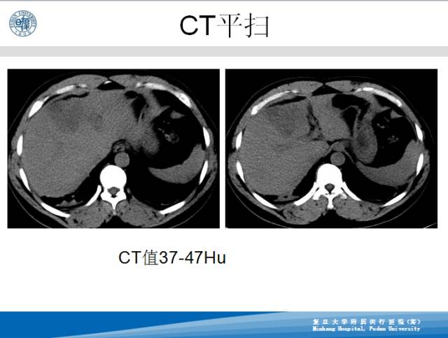 【病例】肝左叶胆管细胞癌1例CT及MR影像表现