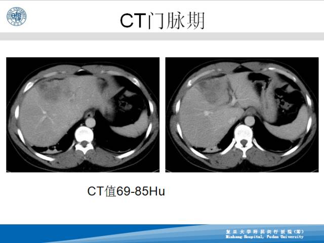 【病例】肝左叶胆管细胞癌1例CT及MR影像表现