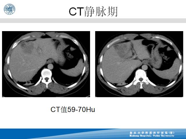【病例】肝左叶胆管细胞癌1例CT及MR影像表现