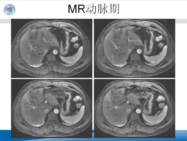【病例】肝左叶胆管细胞癌1例CT及MR影像表现