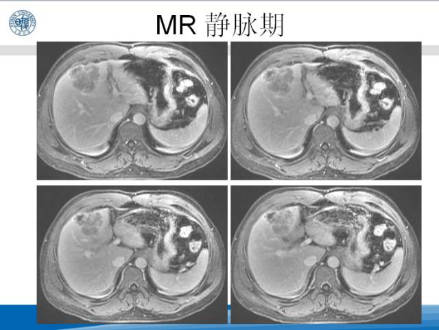 【病例】肝左叶胆管细胞癌1例CT及MR影像表现