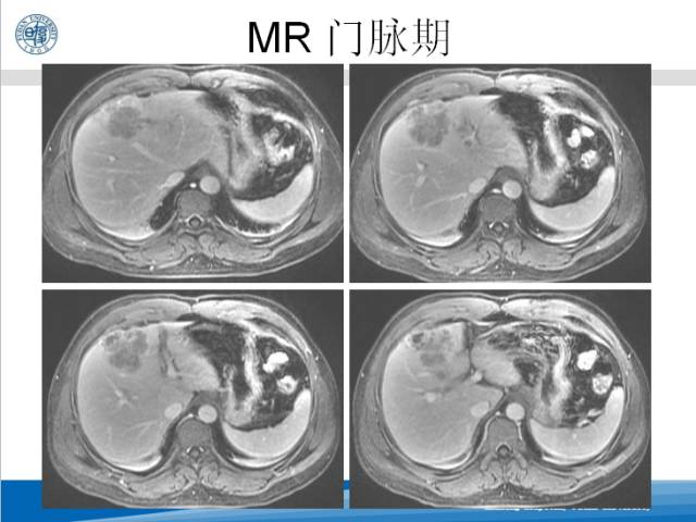 【病例】肝左叶胆管细胞癌1例CT及MR影像表现