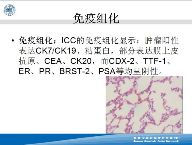【病例】肝左叶胆管细胞癌1例CT及MR影像表现