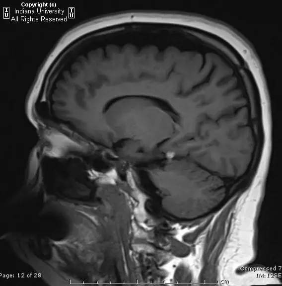 【病例】中脑顶盖脂肪瘤1例MR影像表现 【病例】中脑顶盖脂肪瘤1例MR影像表现