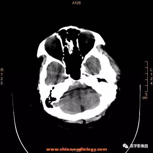【病例】颞顶部肿物向颅外侵犯——恶性脑膜瘤1例CT 【病例】颞顶部肿物向颅外侵犯——恶性脑膜瘤1例CT