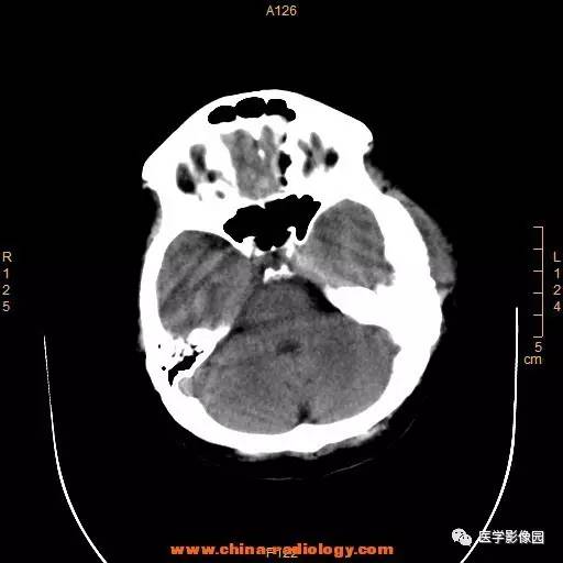 【病例】颞顶部肿物向颅外侵犯——恶性脑膜瘤1例CT 【病例】颞顶部肿物向颅外侵犯——恶性脑膜瘤1例CT