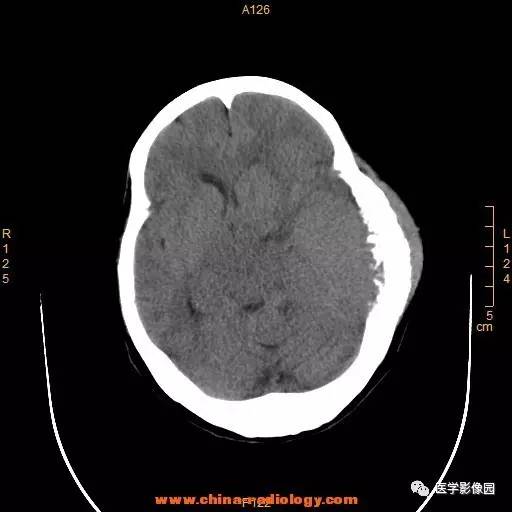 【病例】颞顶部肿物向颅外侵犯——恶性脑膜瘤1例CT 【病例】颞顶部肿物向颅外侵犯——恶性脑膜瘤1例CT
