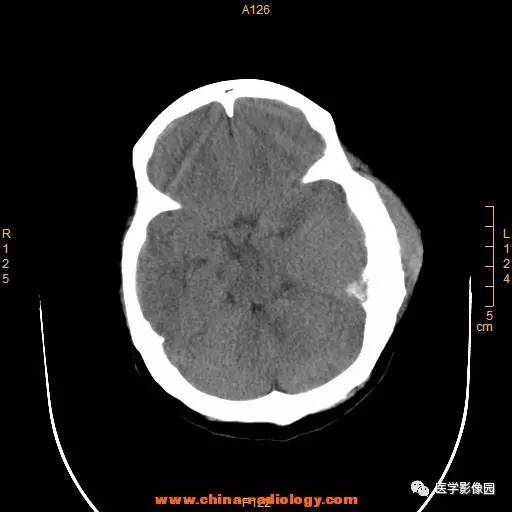 【病例】颞顶部肿物向颅外侵犯——恶性脑膜瘤1例CT