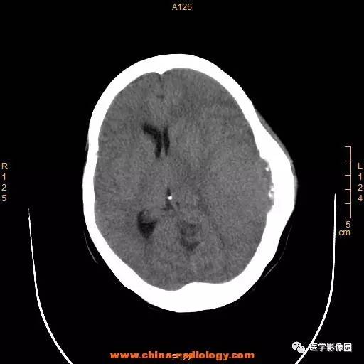 【病例】颞顶部肿物向颅外侵犯——恶性脑膜瘤1例CT 【病例】颞顶部肿物向颅外侵犯——恶性脑膜瘤1例CT