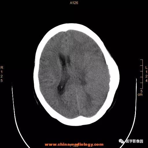 【病例】颞顶部肿物向颅外侵犯——恶性脑膜瘤1例CT 【病例】颞顶部肿物向颅外侵犯——恶性脑膜瘤1例CT