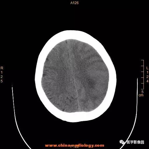 【病例】颞顶部肿物向颅外侵犯——恶性脑膜瘤1例CT 【病例】颞顶部肿物向颅外侵犯——恶性脑膜瘤1例CT