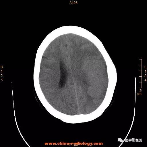 【病例】颞顶部肿物向颅外侵犯——恶性脑膜瘤1例CT 【病例】颞顶部肿物向颅外侵犯——恶性脑膜瘤1例CT