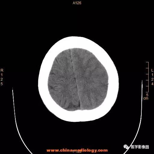 【病例】颞顶部肿物向颅外侵犯——恶性脑膜瘤1例CT 【病例】颞顶部肿物向颅外侵犯——恶性脑膜瘤1例CT