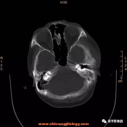 【病例】颞顶部肿物向颅外侵犯——恶性脑膜瘤1例CT 【病例】颞顶部肿物向颅外侵犯——恶性脑膜瘤1例CT