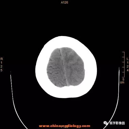 【病例】颞顶部肿物向颅外侵犯——恶性脑膜瘤1例CT 【病例】颞顶部肿物向颅外侵犯——恶性脑膜瘤1例CT