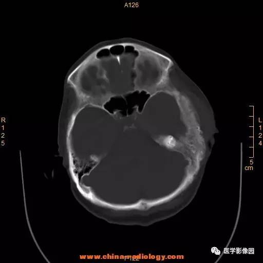 【病例】颞顶部肿物向颅外侵犯——恶性脑膜瘤1例CT 【病例】颞顶部肿物向颅外侵犯——恶性脑膜瘤1例CT