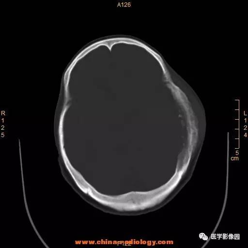 【病例】颞顶部肿物向颅外侵犯——恶性脑膜瘤1例CT 【病例】颞顶部肿物向颅外侵犯——恶性脑膜瘤1例CT