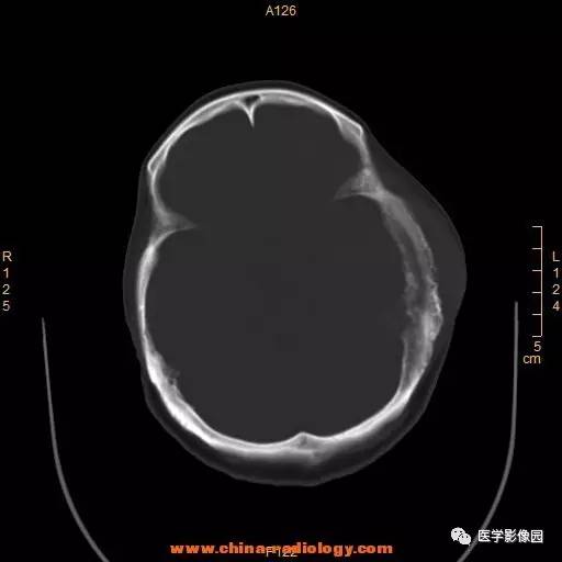 【病例】颞顶部肿物向颅外侵犯——恶性脑膜瘤1例CT 【病例】颞顶部肿物向颅外侵犯——恶性脑膜瘤1例CT