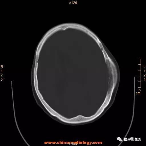 【病例】颞顶部肿物向颅外侵犯——恶性脑膜瘤1例CT 【病例】颞顶部肿物向颅外侵犯——恶性脑膜瘤1例CT