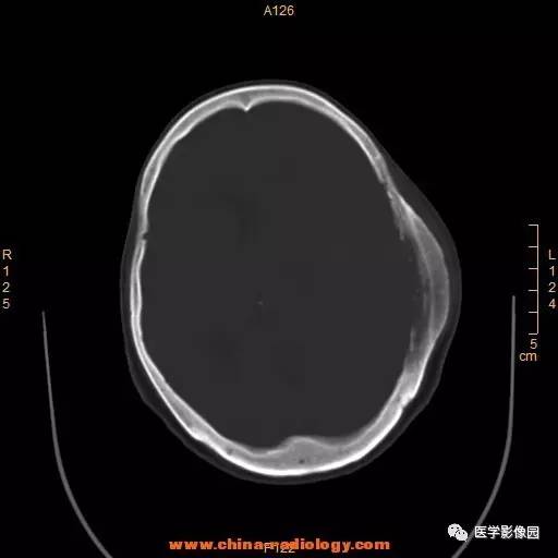【病例】颞顶部肿物向颅外侵犯——恶性脑膜瘤1例CT 【病例】颞顶部肿物向颅外侵犯——恶性脑膜瘤1例CT