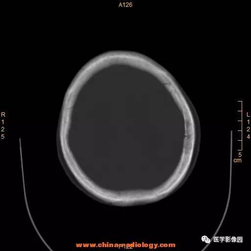 【病例】颞顶部肿物向颅外侵犯——恶性脑膜瘤1例CT 【病例】颞顶部肿物向颅外侵犯——恶性脑膜瘤1例CT